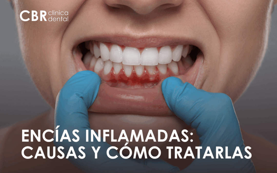 Persona con encías inflamadas