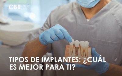 Tipos de implantes dentales: ¿Cuál es el mejor para tu caso?